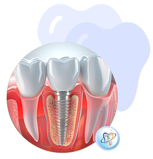 Dental Braces